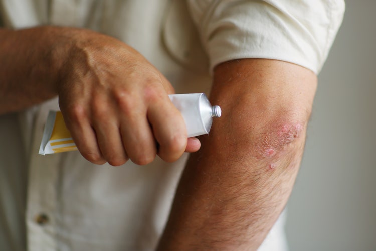 can glutathione cause eczema Celiac Disease and Injections - Allure Medical Boosts Immune Health Quantity:10 Units Pack