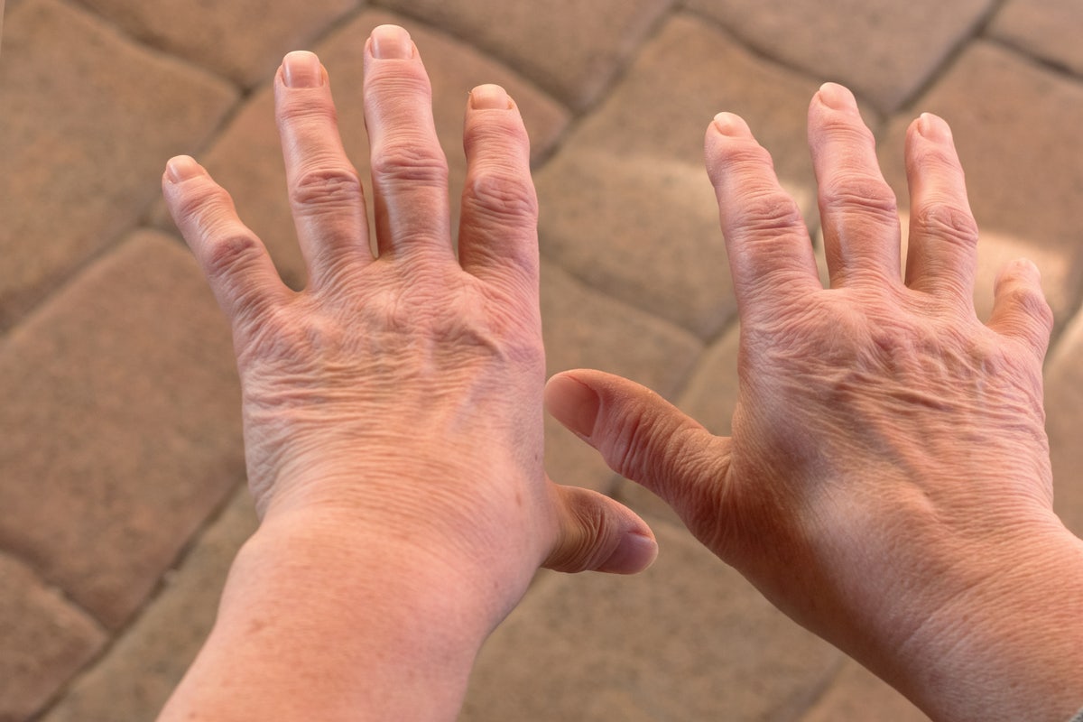 Celiac Disease and Rheumatoid Arthritis - Feline Celiac Disease And Rheumatoid Arthritis