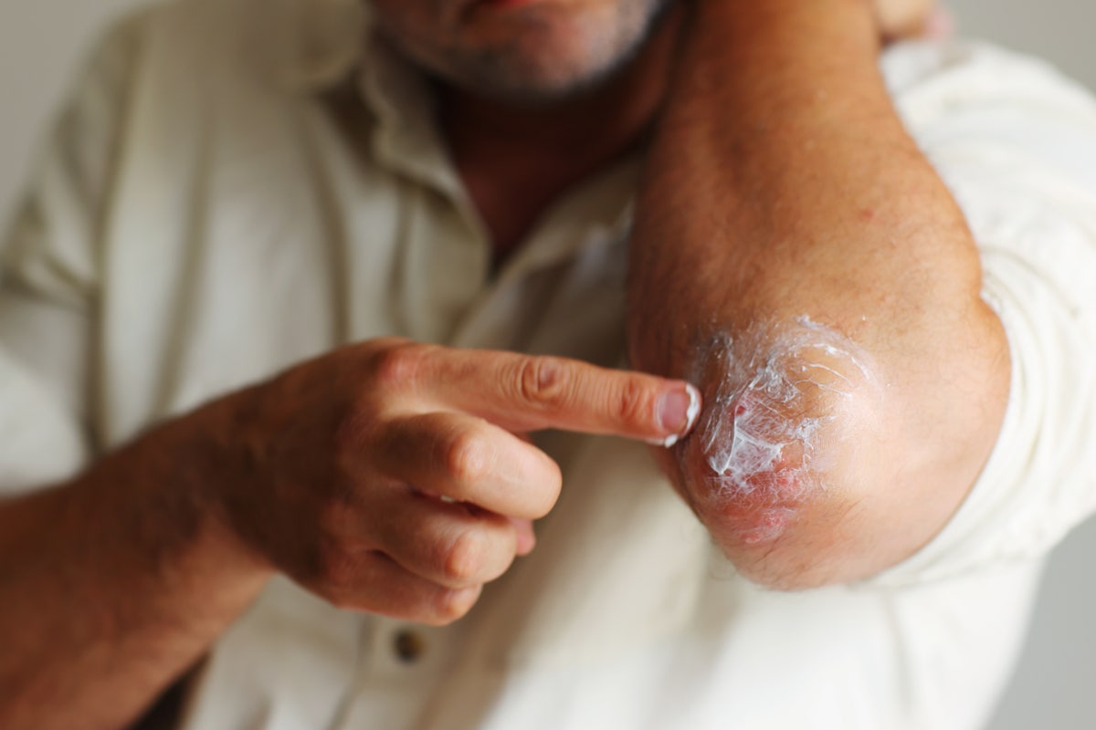 About Staph Infection | Health Answers by Pfizer